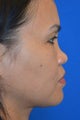 Nonsurgical Rhinoplasty for Bridge and Tip Augmentation/Refinement