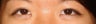Bilateral Asian Eyelid Surgery