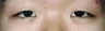 Bilateral Asian Eyelid Surgery