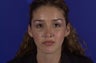 Revision Rhinoplasty