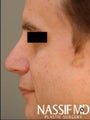 Male Revision Rhinoplasty