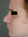 Male Revision Rhinoplasty