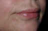 Lip Augmentation in middle aged lady