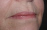 Lip Augmentation in middle aged lady