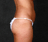 CoolSculpting