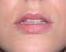 Injectables