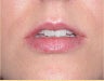 Injectables