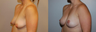 Breast Lift