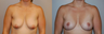 Breast Lift