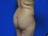 37 year old Brazilian Butt Lift - 2nd view