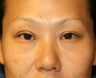 Double Eyelid Procedure