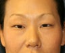 Double Eyelid Procedure