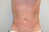 43 Year Old Male treated for fat removal and to enhance tissue tightening - Smartlipo