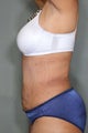 51 Year Old Female Treated for UnWanted Fat With SmartLipo and Vaser Laser