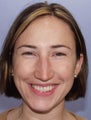 Female Chin Osteotomy