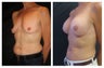 Breast Implants