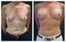 Breast Implants