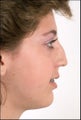 Rhinoplasty