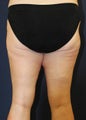 Thigh Lift