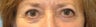 63 Year Old Female Treated for Dermatachalasis of Lower Eyelids