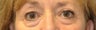 63 Year Old Female Treated for Dermatachalasis of Lower Eyelids