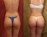Buttock Augmentation or BBL