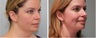Neck lift Before and 2 months after surgery