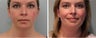 Neck lift Before and 2 months after surgery