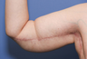 38 year old female treated for arm laxity following massive weight loss