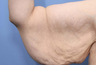 38 year old female treated for arm laxity following massive weight loss