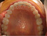 Invisalign treatment for spaced out teeth