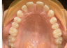 Invisalign treatment for spaced out teeth