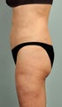 60 yr old female Smartlipo Laser Liposuction - Abdomen, hips, flanks, pubis 2 mo post op