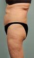 60 yr old female Smartlipo Laser Liposuction - Abdomen, hips, flanks, pubis 2 mo post op