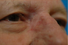 Reconstruction of medial canthus defect