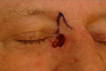 Reconstruction of medial canthus defect