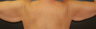 Brachioplasty