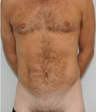 Male Liposuction - 3 months post op