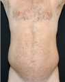 Male Liposuction - 3 months post op