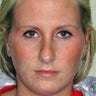 28 Year-Old Female Treated For Protruding Ears