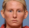 28 Year-Old Female Treated For Protruding Ears