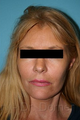Facelift