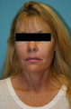 Facelift