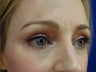 Lower eyelid hyaluronic acid (Restylane)