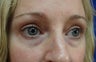 Lower eyelid hyaluronic acid (Restylane)