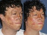 Before & After Laser Resurfacing