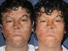 Before & After Laser Resurfacing