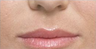 Restylane