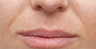 Restylane
