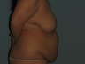 Patient underwent a breast lift (mastopexy),